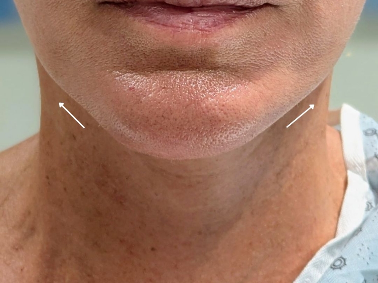 Facelift before and after - after