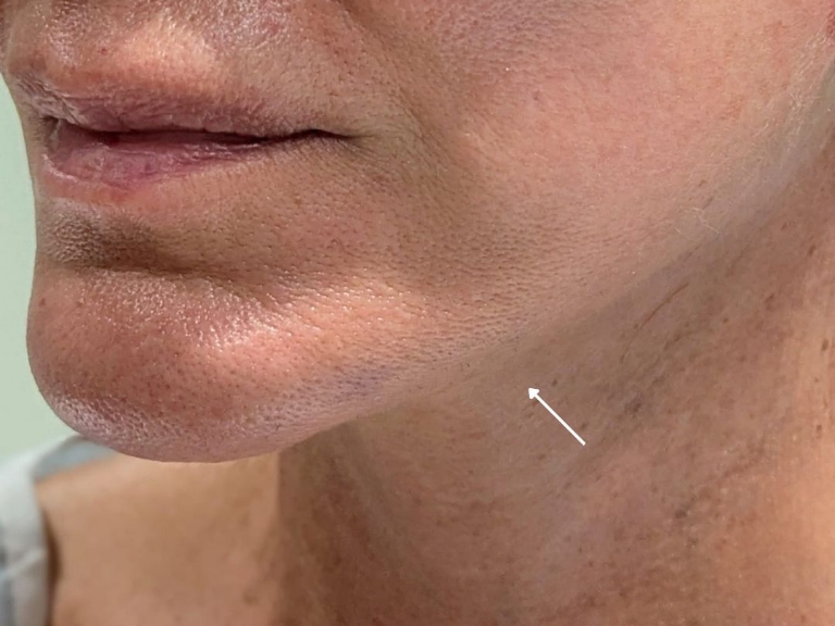 Facelift before and after - after