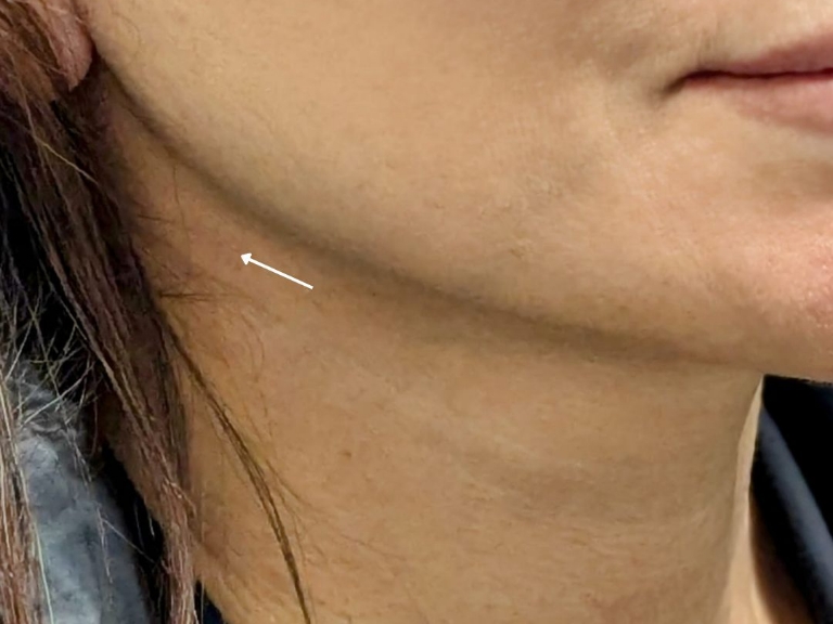 Facelift before and after - after