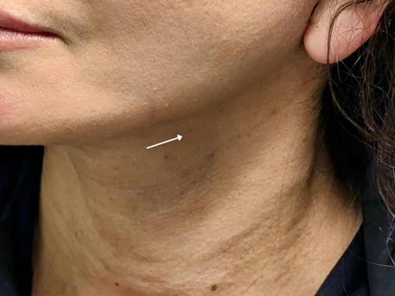 Facelift before and after - after