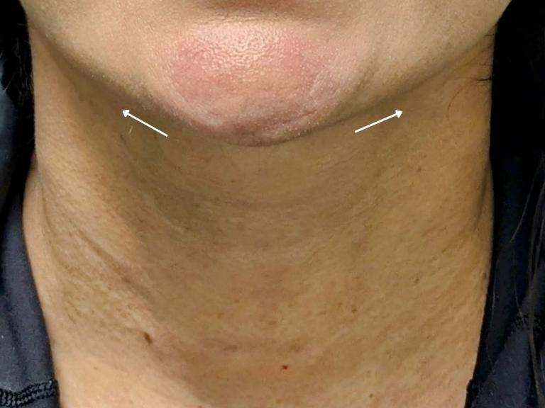 Facelift before and after - after
