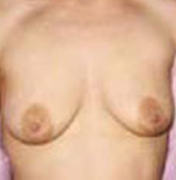 Breast Lift before and after - before