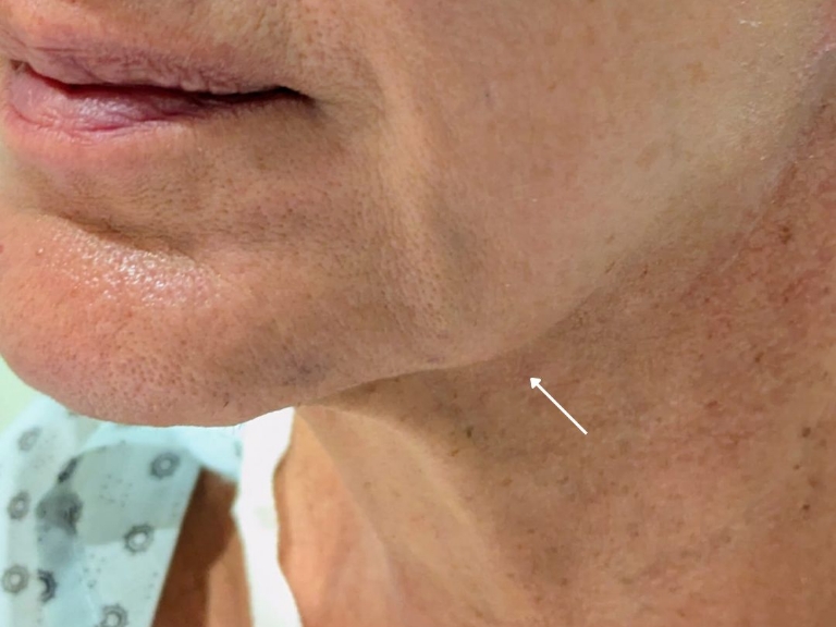 Facelift before and after - before