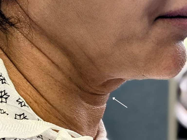 Facelift before and after - before