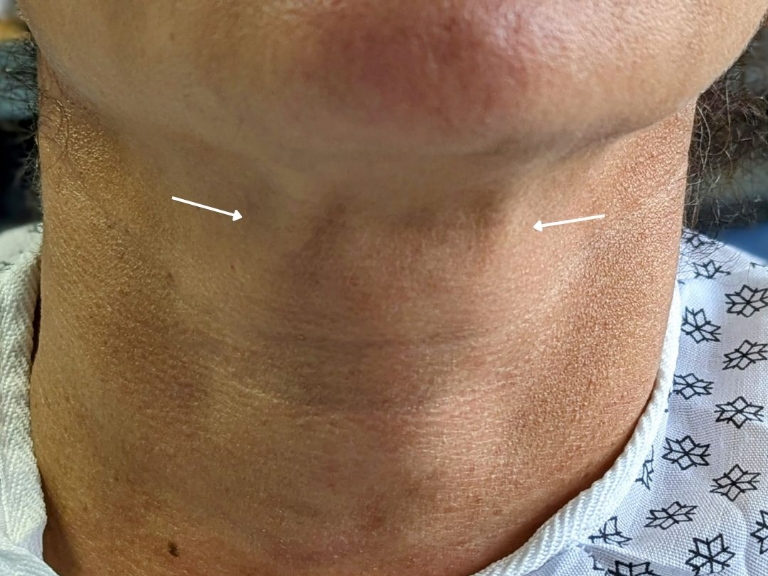 Facelift before and after - before