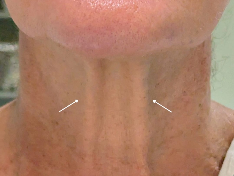 Facelift before and after - before
