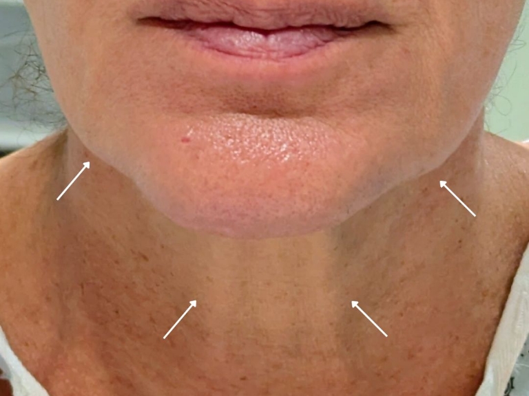 Facelift before and after - before