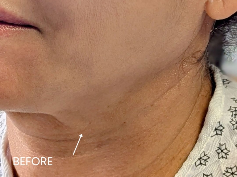 Facelift before and after - before