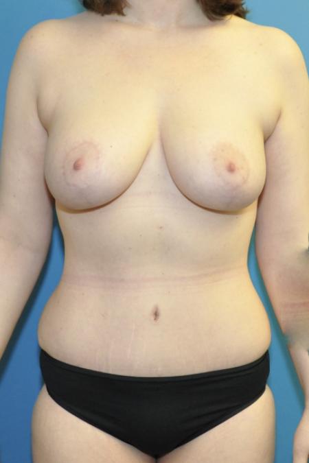 Mommy Makeover before and after - after