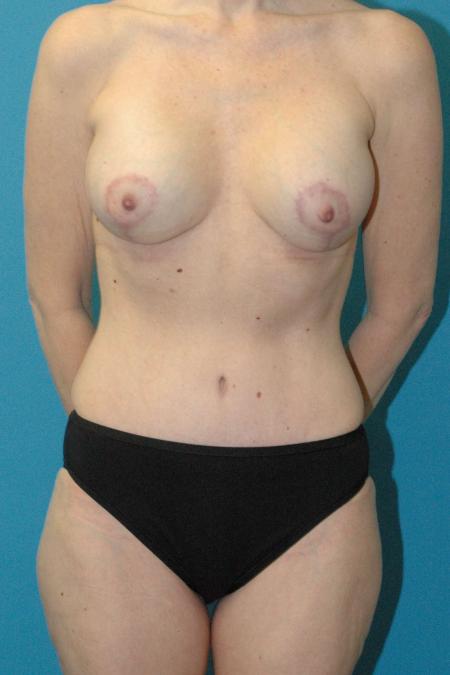 Mommy Makeover before and after - after