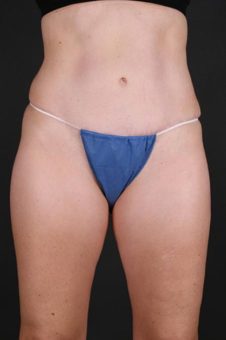 Tummy Tuck before and after - after