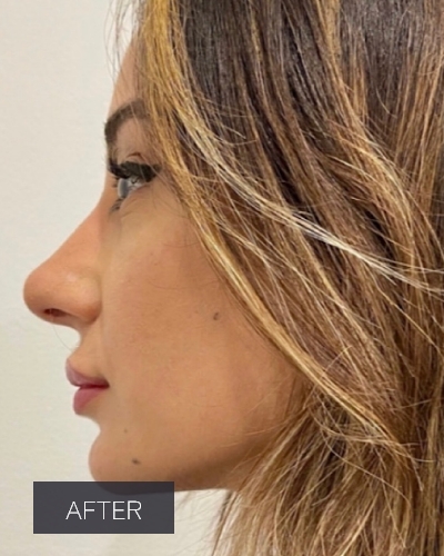 Procedure before and after - after