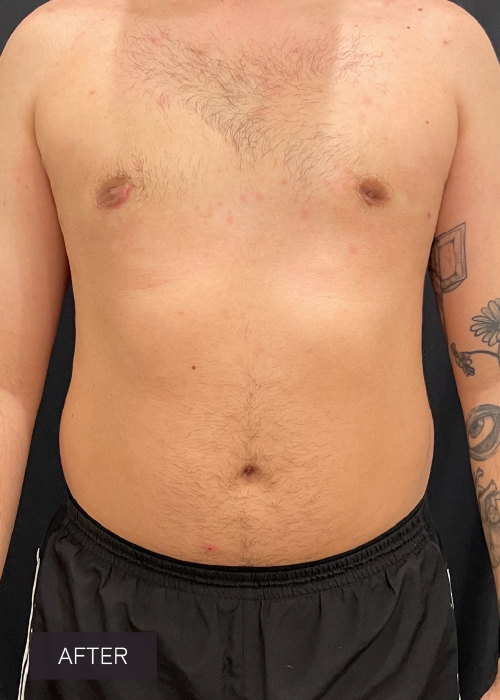 Procedure before and after - after