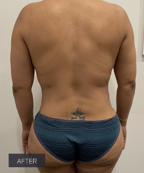 Procedure before and after - after