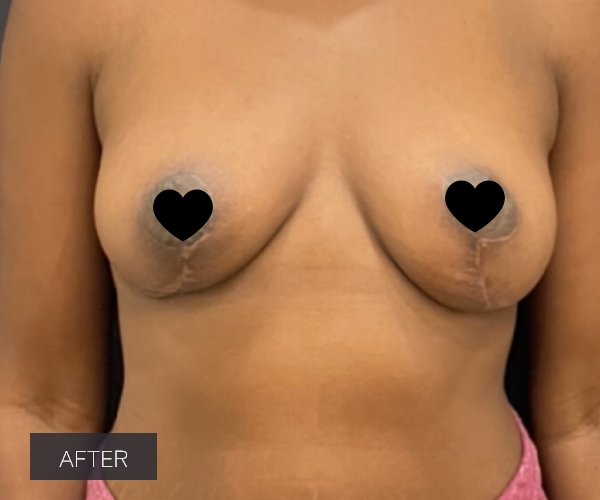 Procedure before and after - after
