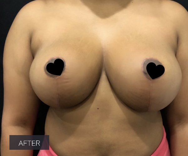 Procedure before and after - after