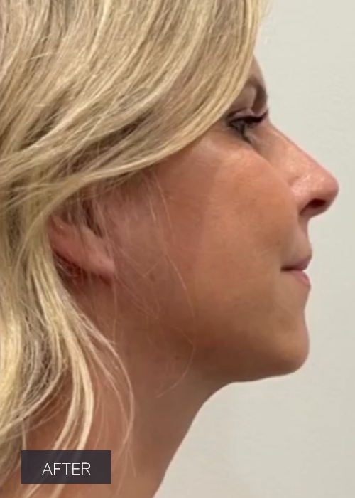 Procedure before and after - after