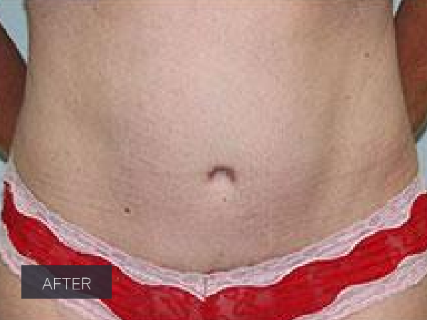 Procedure before and after - after