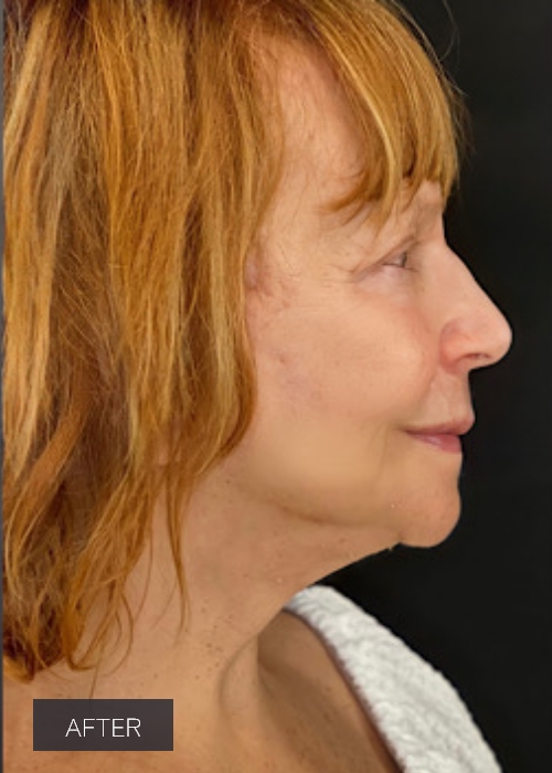 Procedure before and after - after