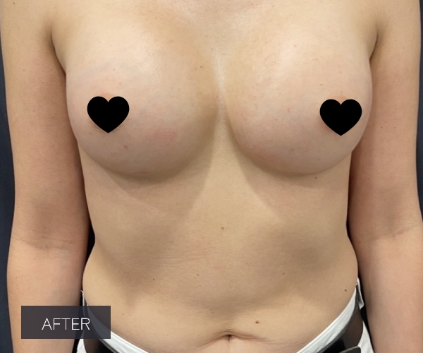 Procedure before and after - after