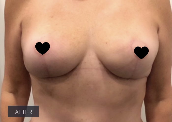 Procedure before and after - after