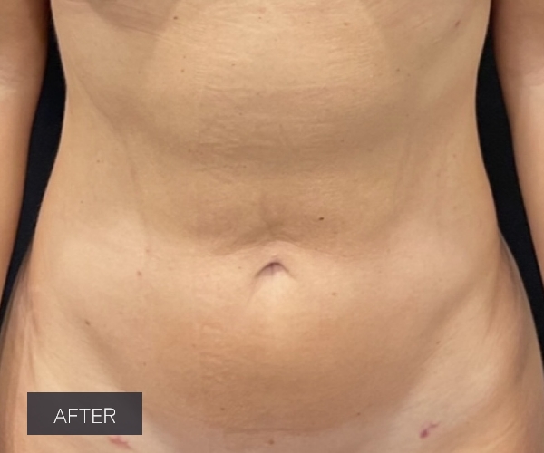 Procedure before and after - after