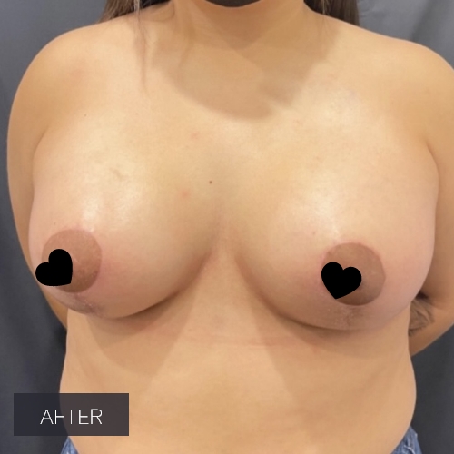 Procedure before and after - after
