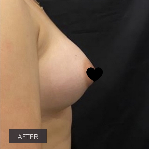 Procedure before and after - after