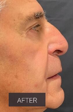 Procedure before and after - after