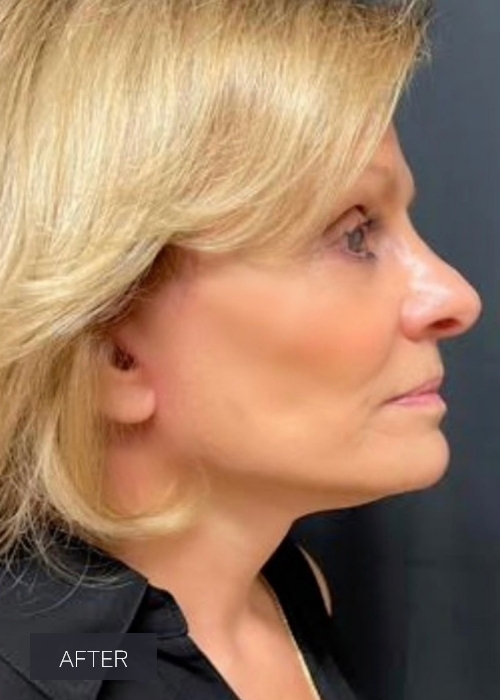 Procedure before and after - after