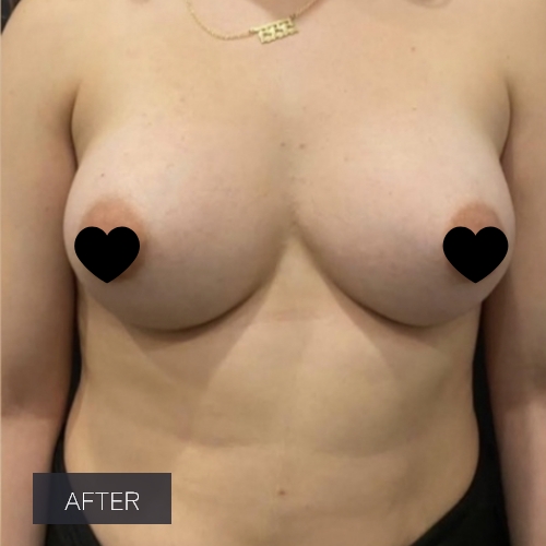 Procedure before and after - after