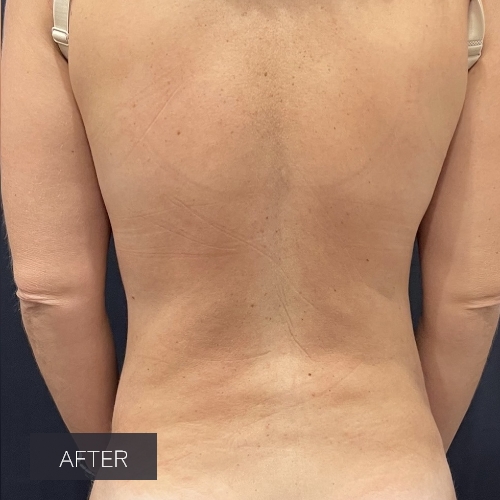 Procedure before and after - after