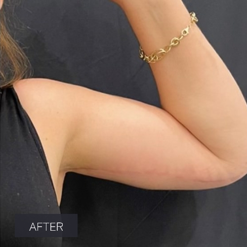 Procedure before and after - after