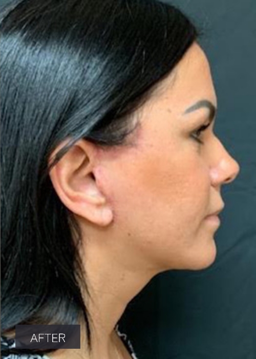 Procedure before and after - after