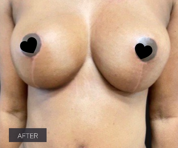 Procedure before and after - after