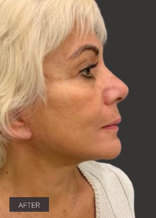 Procedure before and after - after