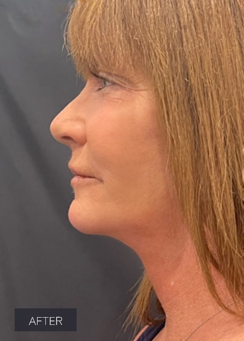 Procedure before and after - after