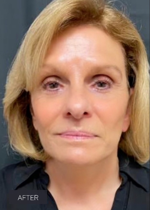 Procedure before and after - after