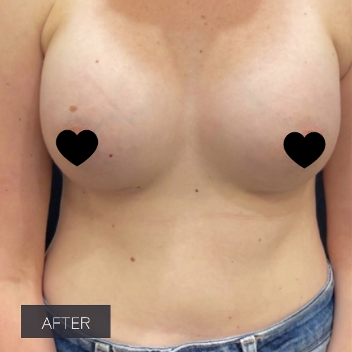 Procedure before and after - after