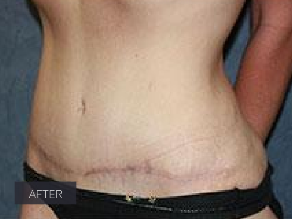 Procedure before and after - after