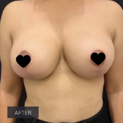 Procedure before and after - after