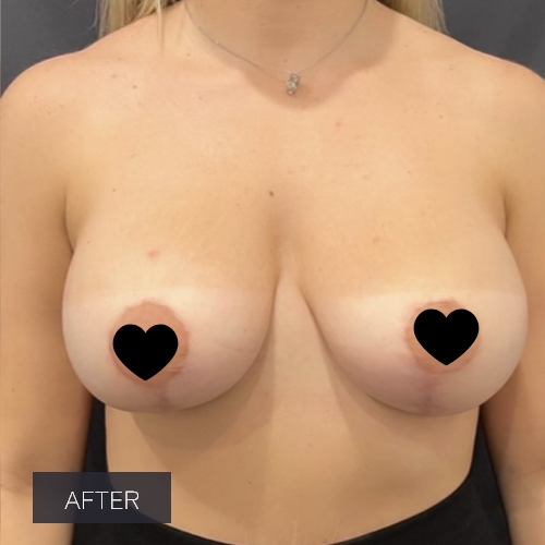 Procedure before and after - after