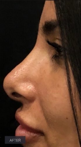 Procedure before and after - after