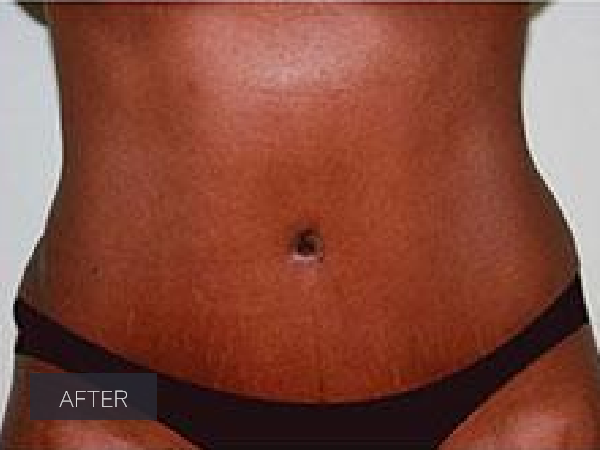 Tummy Tuck before and after - after