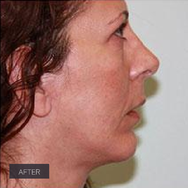 Procedure before and after - after