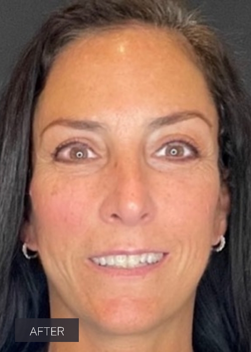 Procedure before and after - after
