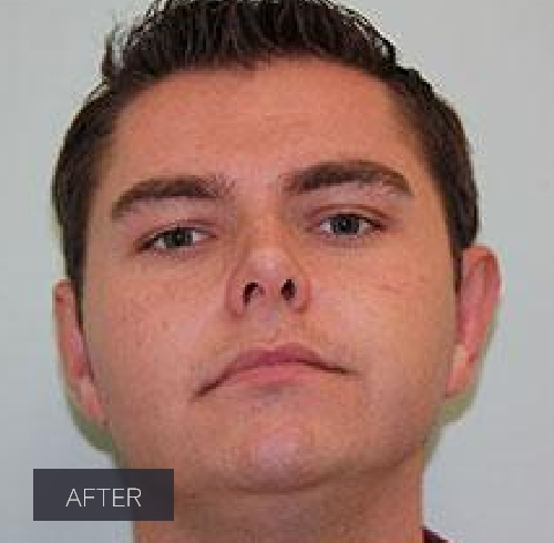 Procedure before and after - after