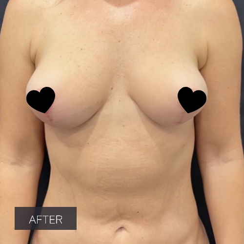 Procedure before and after - after
