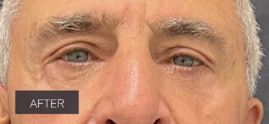 Procedure before and after - after