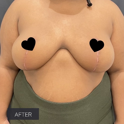 Procedure before and after - after